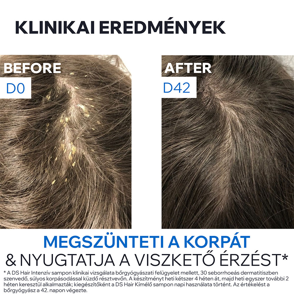URIAGE DS HAIR intenzív sampon erősen korpás fejbőrre (150ml) 